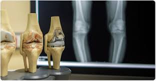Osteoarthritis (oa) is a type of degenerative joint disease that results from breakdown of joint cartilage and underlying bone. Osteoarthritis Complications