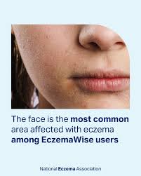 Image result for ekzema face