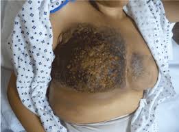 Inflammatory breast cancer symptoms include: Inflammatory Breast Cancer