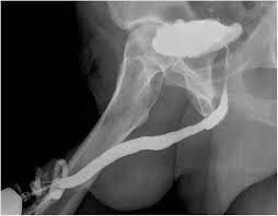 Image result for Retrograde Urethrogram