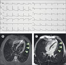 Myocarditis is an inflammation of the heart muscle that decreases the ability of the heart to pump blood normally. Myocarditis In A 16 Year Old Boy Positive For Sars Cov 2 The Lancet