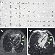 Myocarditis is an inflammatory disease of the myocardium that may present with sudden cardiac death, symptoms mimicking myocardial infarction, heart rhythm and conduction disorders, and heart failure. Myocarditis In A 16 Year Old Boy Positive For Sars Cov 2 The Lancet
