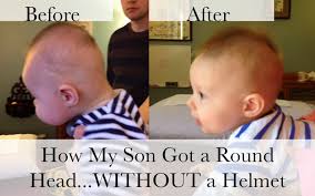 How We Squeezed My Son S Head To Avoid A Helmet Baby Head Shape Baby Helmet Flat Head Baby