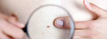 They are due to the development of abnormal cells that have the ability to invade or spread to other parts of the body. Melanoma Treatment Causes Types Early Signs Symptoms