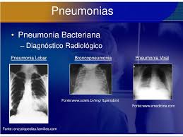 Bacterial pneumonia is a type of pneumonia caused by bacterial infection. Ppt Pneumonias Powerpoint Presentation Free Download Id 791958