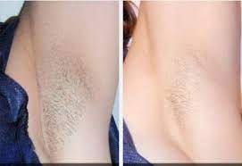 Looking for the best laser hair removal in usa and overwhelmed by the options? Laser Hair Removal Anaheim Hills Ca Huntington Beach Orange County