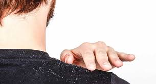 You will definitely suffer from dandruff. 9 Home Remedies To Get Rid Of Dandruff Naturally