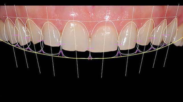 Benefits of Digital Smile Design istanbul
