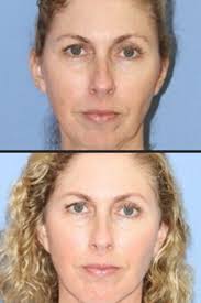Female Facelift Women Over 5 Procedure Pictures Near Newport Beach Ca The Gallery Of Cosmetic Surgery Is Cosmetic Surgery Facial Plastic Surgery Rhinoplasty
