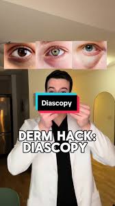 Image result for Diascopy