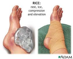 R I C E Sprained Ankle Sprain Sprain Treatment