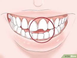If left untreated, a cavity will get worse and could lead to increased discomfort in the affected tooth. 3 Ways To Know If Your Dental Fillings Need Replacing Wikihow