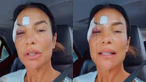 Ivete Sangalo brinca com hematoma no rosto: expectativa x realidade