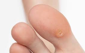 Image result for Corns