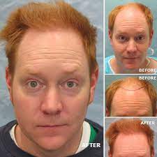 See more ideas about hair loss medication, hair loss, bernstein. Pin On Hair Transplant Photos