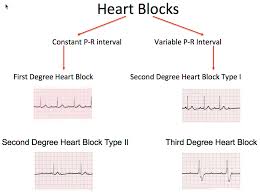 316 heart block dysrhythmias