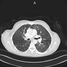 Auscultation of the lungs adventitious (added) sounds three types of adventitious sounds can be a soft friction rub in early dry pleurisy may be mistaken for crepitation or fine bubbling rales but is not a. Interstitial Lung Disease In A Hot Tub User