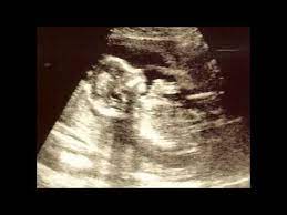 Bebeğin cinsiyeti en erken ve kesin ne zaman belli olur, cinsiyeti belirleme, ultrason sonuçları dr. Bebegin Cinsiyeti Ne Zaman Belli Olur 2015 Youtube