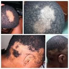 Image result for Anthralin