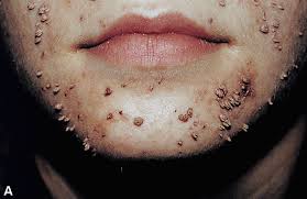 Image result for verrucae filiformes