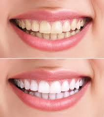 Maybe you would like to learn more about one of these? Hydrogen Peroxide For Teeth Whitening 6 Home Remedies To Whiten Teeth