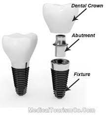 How Much For Dental Implants In Canada