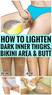 How To Get Rid Of Dark Inner Thighs Naturally In 2020 Health And Fitness Articles Beauty Skin Care Routine Skin Care Remedies