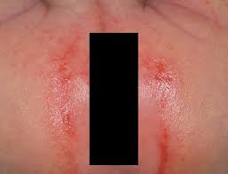 Image result for diaper dermatitis