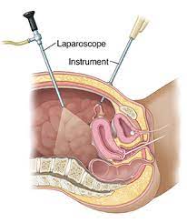 Pelvic anatomy mri variant anatomy pelvic viscera. Pelvic Laparoscopy Saint Luke S Health System