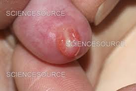 Image result for Balanitis