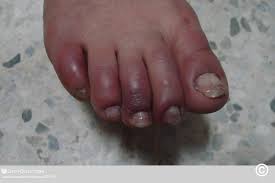 Image result for Chilblains