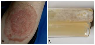 Image result for penis mycosis symptoms