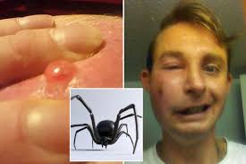 Where'd that come from, natasha?. False Widow Spider Bite Leaves Man With Fat Sausage Finger That Exploded Daily Star