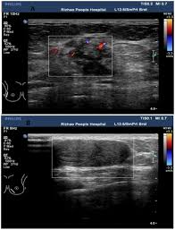 Ultrasound is only one means of evaluation of the breast. Clinical Value Of Color Doppler Ultrasound Combined With Serum Ca153 Cea And Tsgf Detection In The Diagnosis Of Breast Cancer