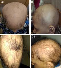 Image result for Anthralin