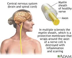 Multiple sclerosis affects 2.5 million people worldwide, including 400,000 americans. Multiple Sclerosis Medlineplus Medical Encyclopedia