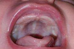 Jun 07, 2019 · a baby's tongue is the main factor in developing the form of the hard palate. Infant Nursing Challenges And Concerns Infant Laser Dentistry