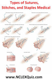 Apr 14, 2016 · staples are often used for head wound closure. Different Types Of Stitches For Surgery Novocom Top