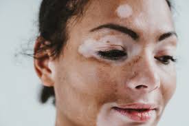 Image result for Vitiligo