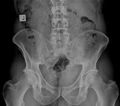 Page 3 of 15 (wow) bony pelvis anatomy radiographs ct protocols pelvic ring fx x Essential Facts About The Pelvis You Need To Know Optistart Chiropractic