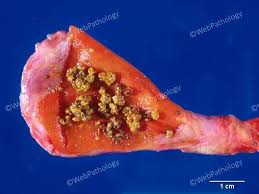 Image result for Gallstone