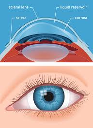 A ground or molded piece of glass, plastic, or other transparent material with opposite surfaces either or both of which are curved, by means of which light rays are refracted so that they converge or diverge to form an image. Scleral Contact Lenses For Keratoconus And Irregular Corneas