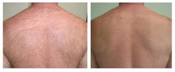 Hair removal via laser can cause temporary irritation. Laser Hair Removal In Dubai Dubai Laser Treatment