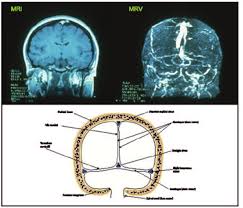 This prevents blood from draining out of the brain. Magnetic Resonance Venography Imaging Of A Cerebral Venous Thrombosis Download Scientific Diagram