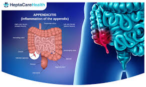 Image result for Appendicitis