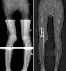 Image result for Genu Varum