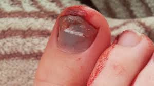 The nail body is made of dead cells, but the nail bed (the tissue underneath the nail body) is alive. Toenail Problems Causes Symptoms And Treatments