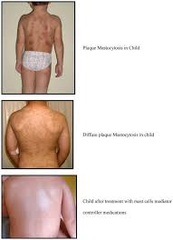 Image result for Urticaria pigmentosa children