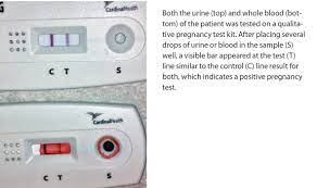 Stat Pregnancy Test Without Urine Emergency Physicians Monthly
