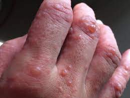 Common causes of hand, foot, and mouth disease are: Apakah Yang Ibu Bapa Perlu Tahu Tentang Penyakit Tangan Kaki Dan Mulut Hfmd The Petri Dish